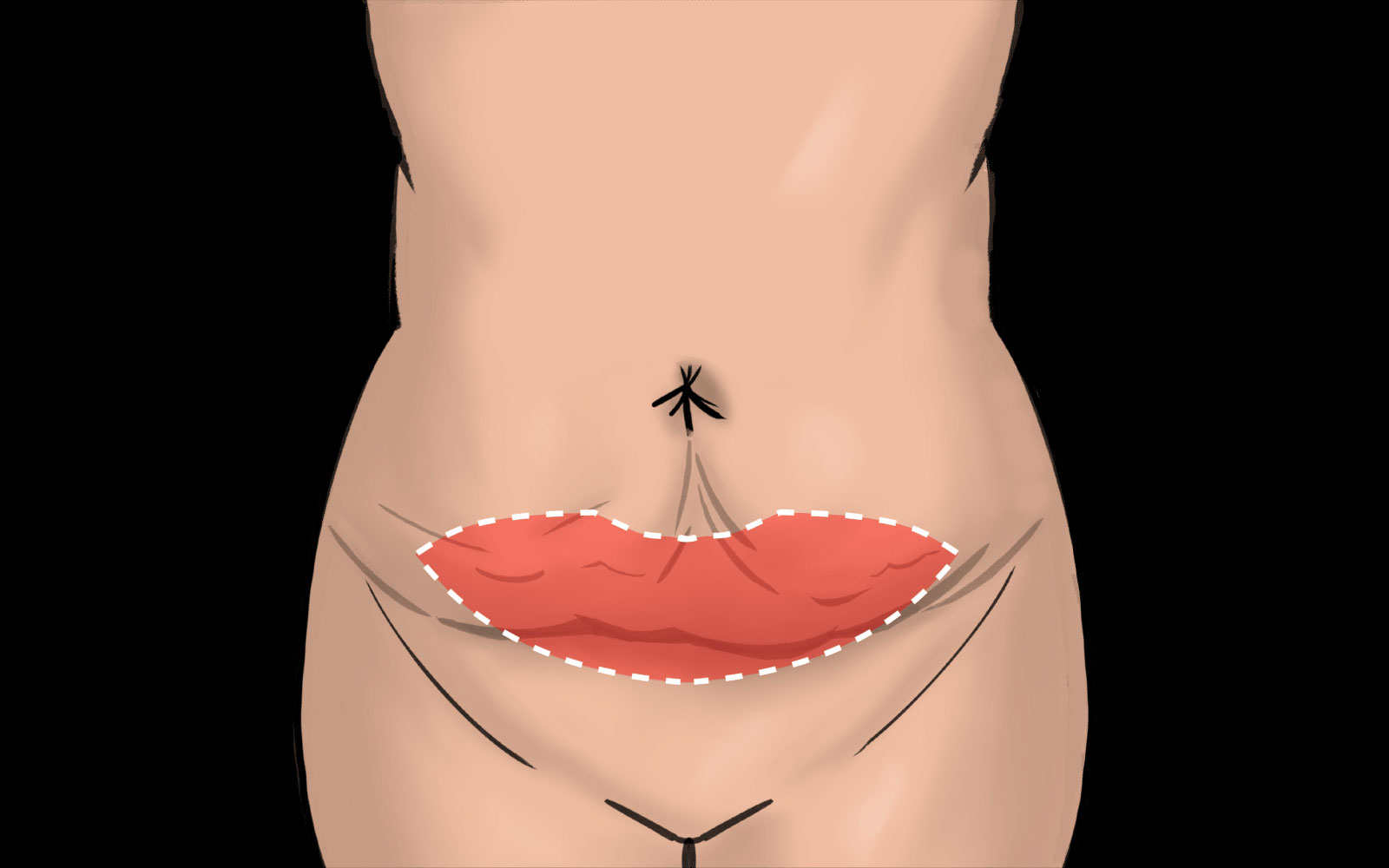 لاغری و حذف چربی با عمل ابدومینوپلاستی و مینی ابدومینوپلاستی