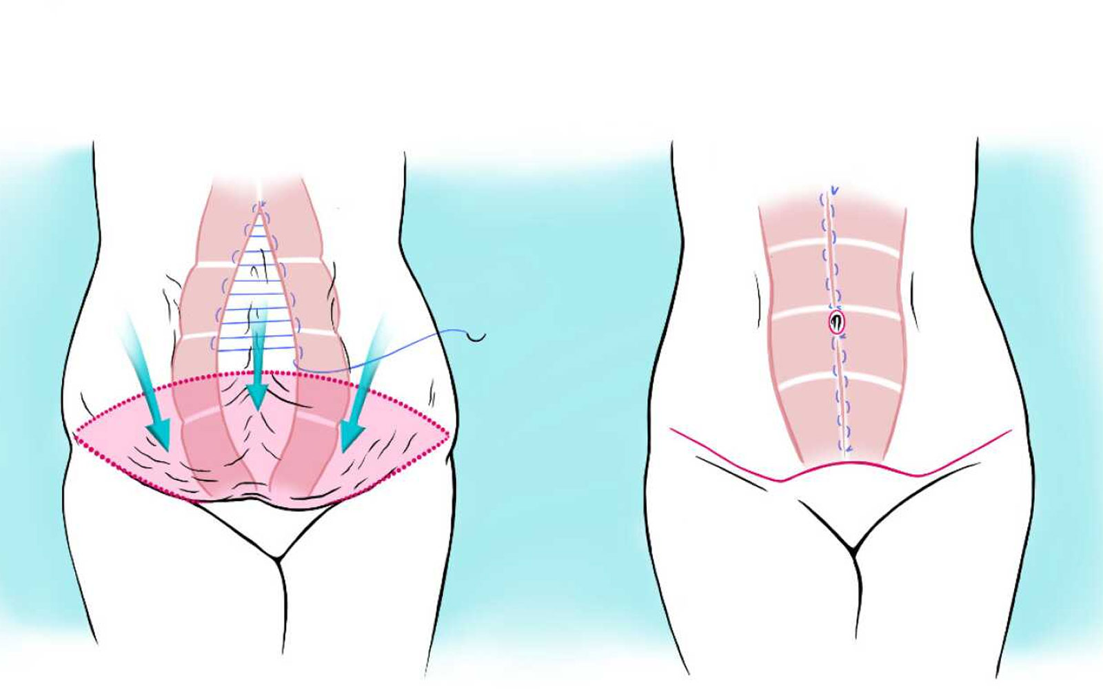 لاغری شکم با ابدومینوپلاستی و مینی ابدومینوپلاستی