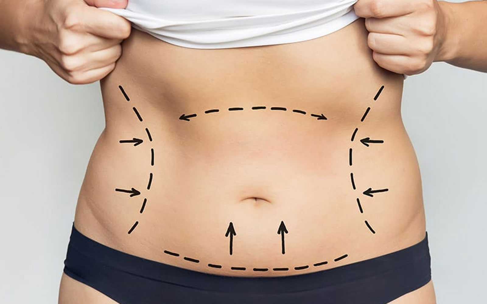 مراقبت های پس از عمل لیپوساکشن