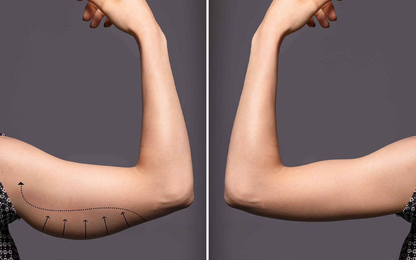 دلایل افتادگی پوست بازو و نیاز به لیفت بازو