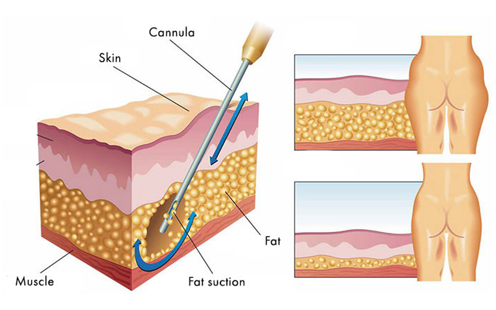 لاغری با لیپوساکشن قبل از بارداری