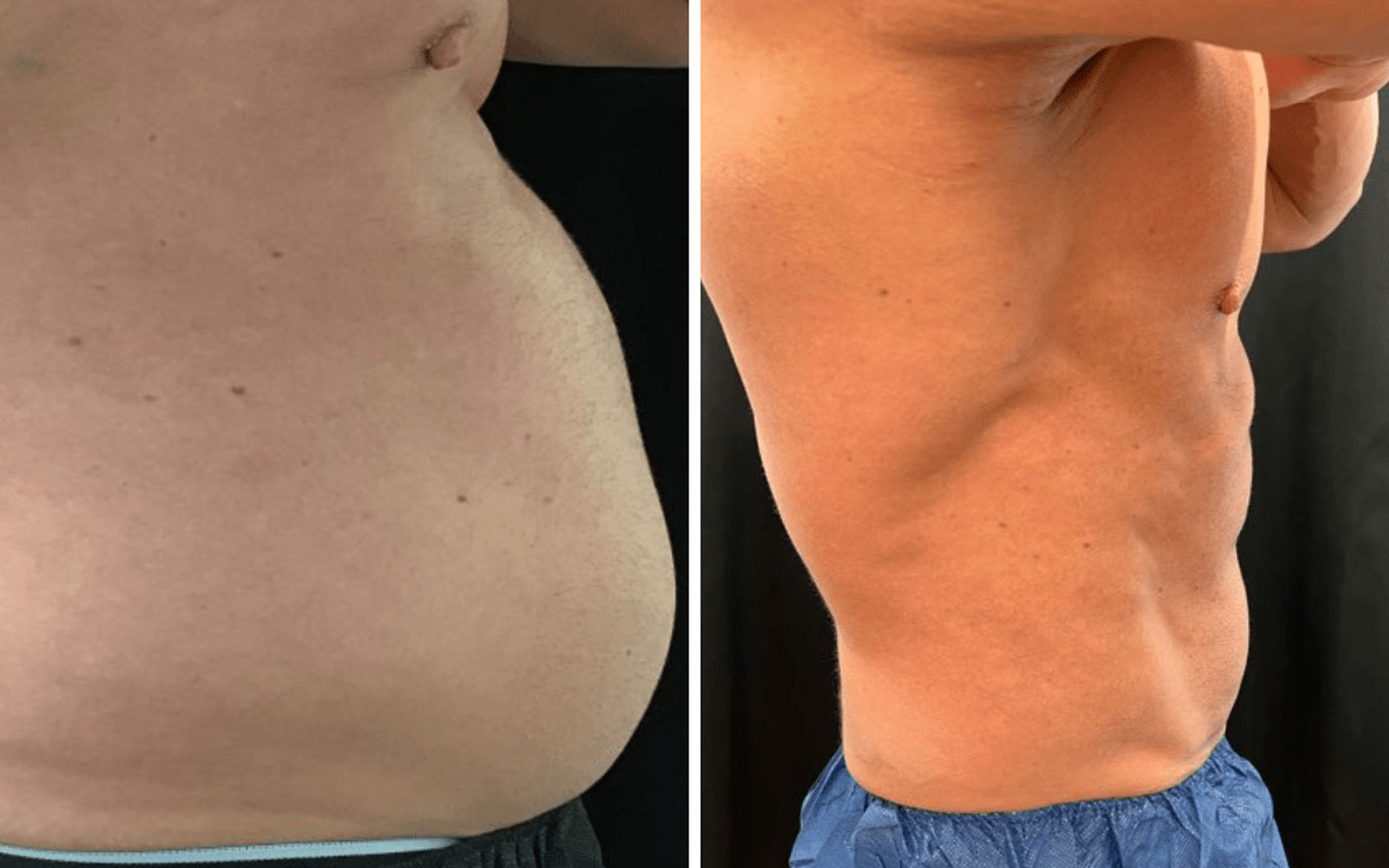 پیکرتراشی افراد چاق