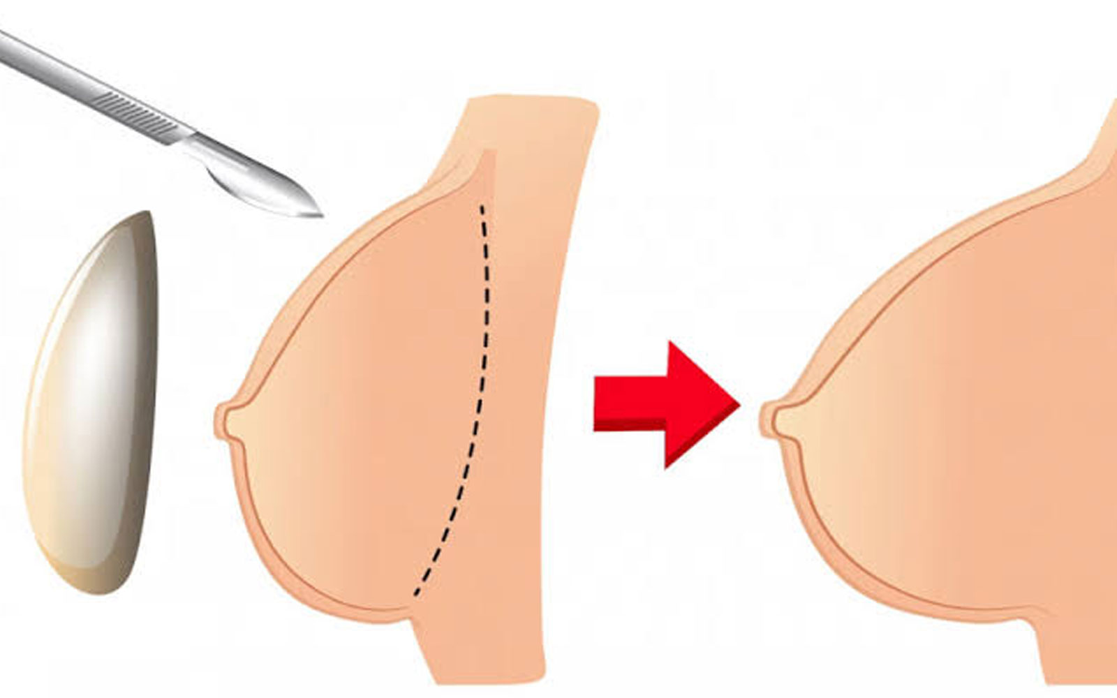 قبل از عمل پروتز سینه این نکات را حتماً بدانید