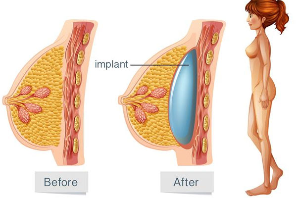 آیا پروتز سینه خطرناک است؟ بررسی علمی عوارض و مراقبت‌ها
