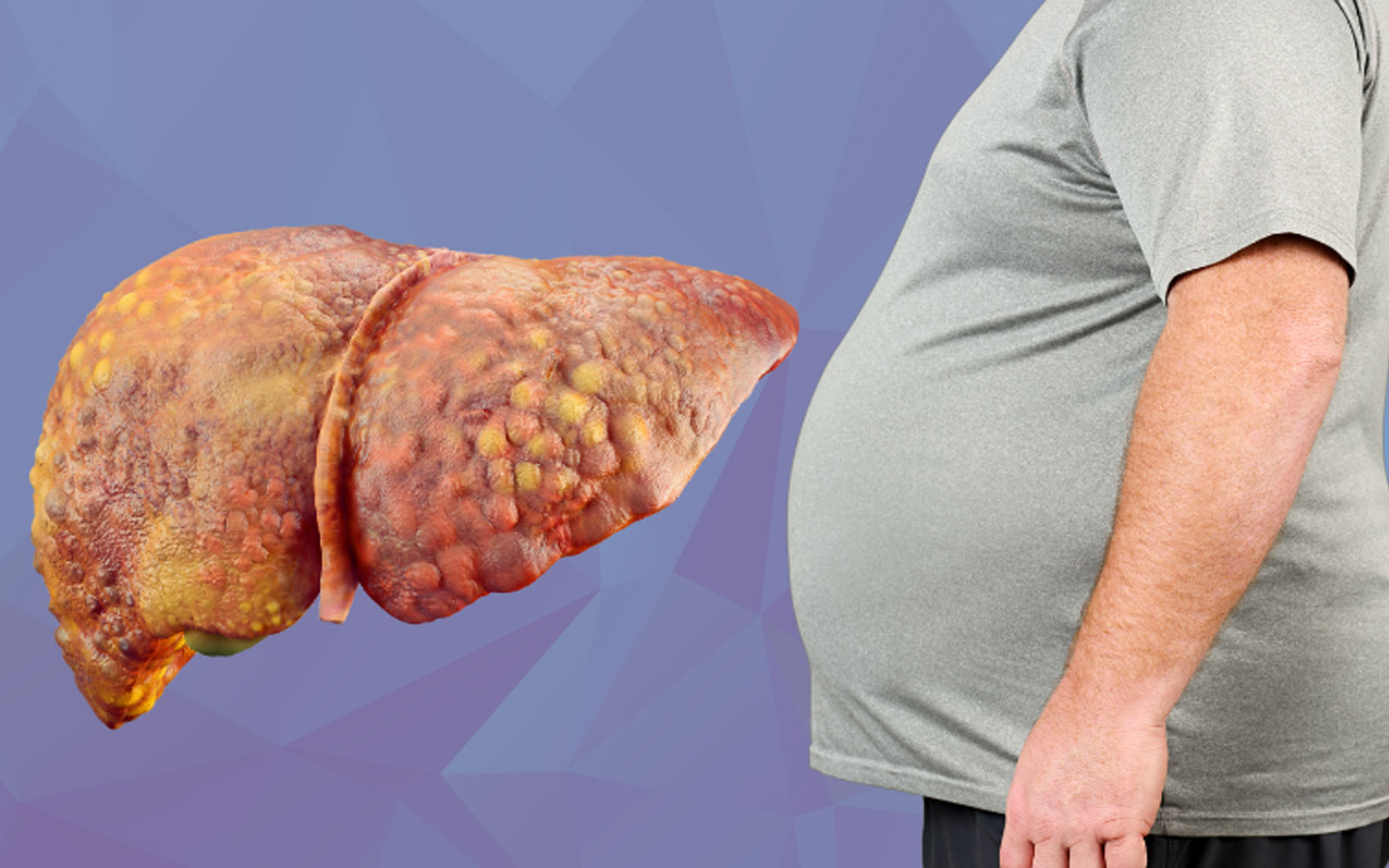 کبد چرب در افراد چاق و راه های درمان آن