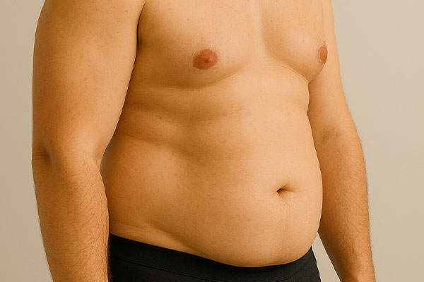چرا برگشت چربی بعد از جراحی بیشتر در پهلو و کمر دیده می‌شود؟