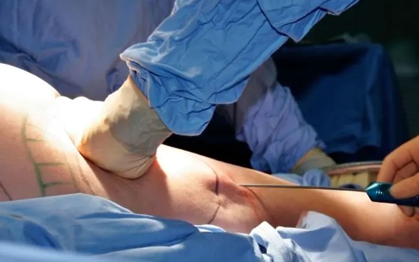 از جدی‌ترین عوارض لیپوساکشن غیرتخصصی