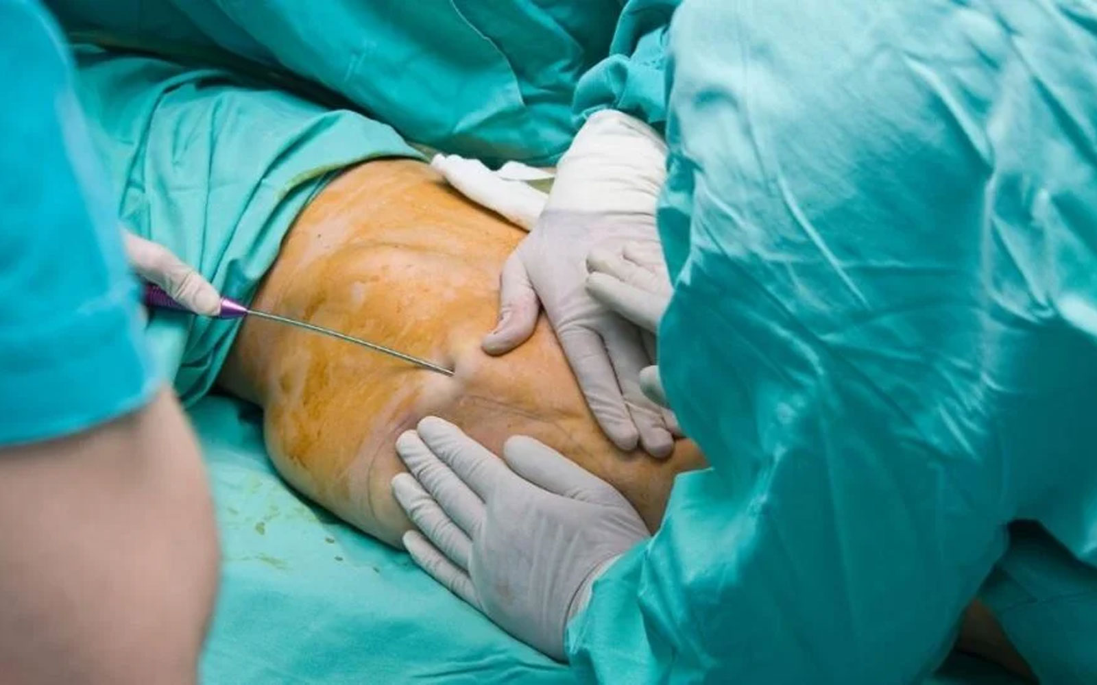 چرا انجام لیپوساکشن در مراکز غیرتخصصی خطرناک است؟