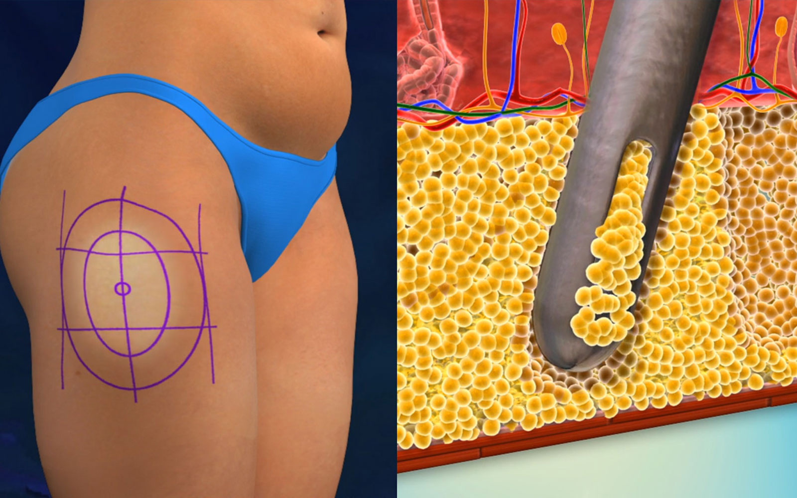 امواج اولتراسوند و شکستن سلولهای چربی