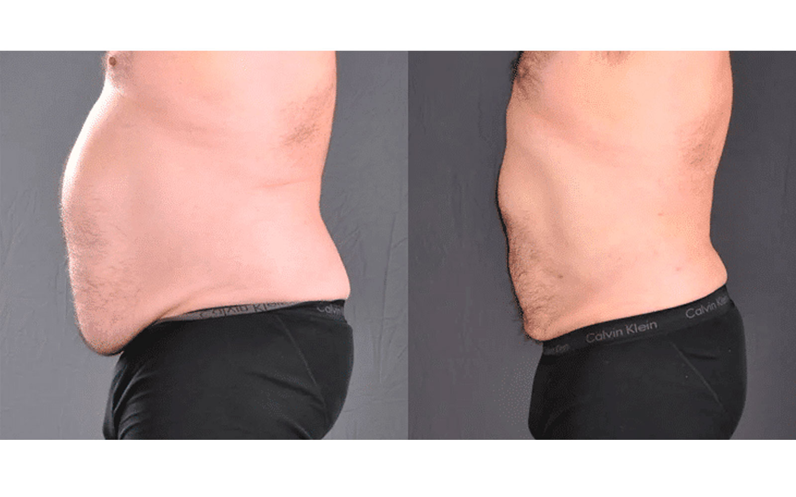 مراقبت‌های دوران نقاهت پیکرتراشی 