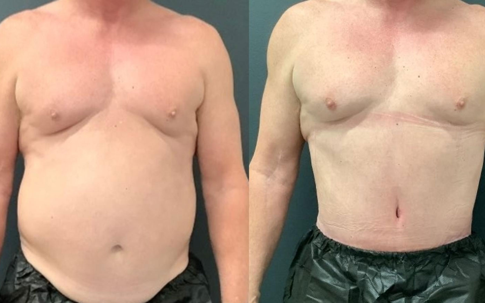 مدت زمان نقاهت پیکرتراشی 