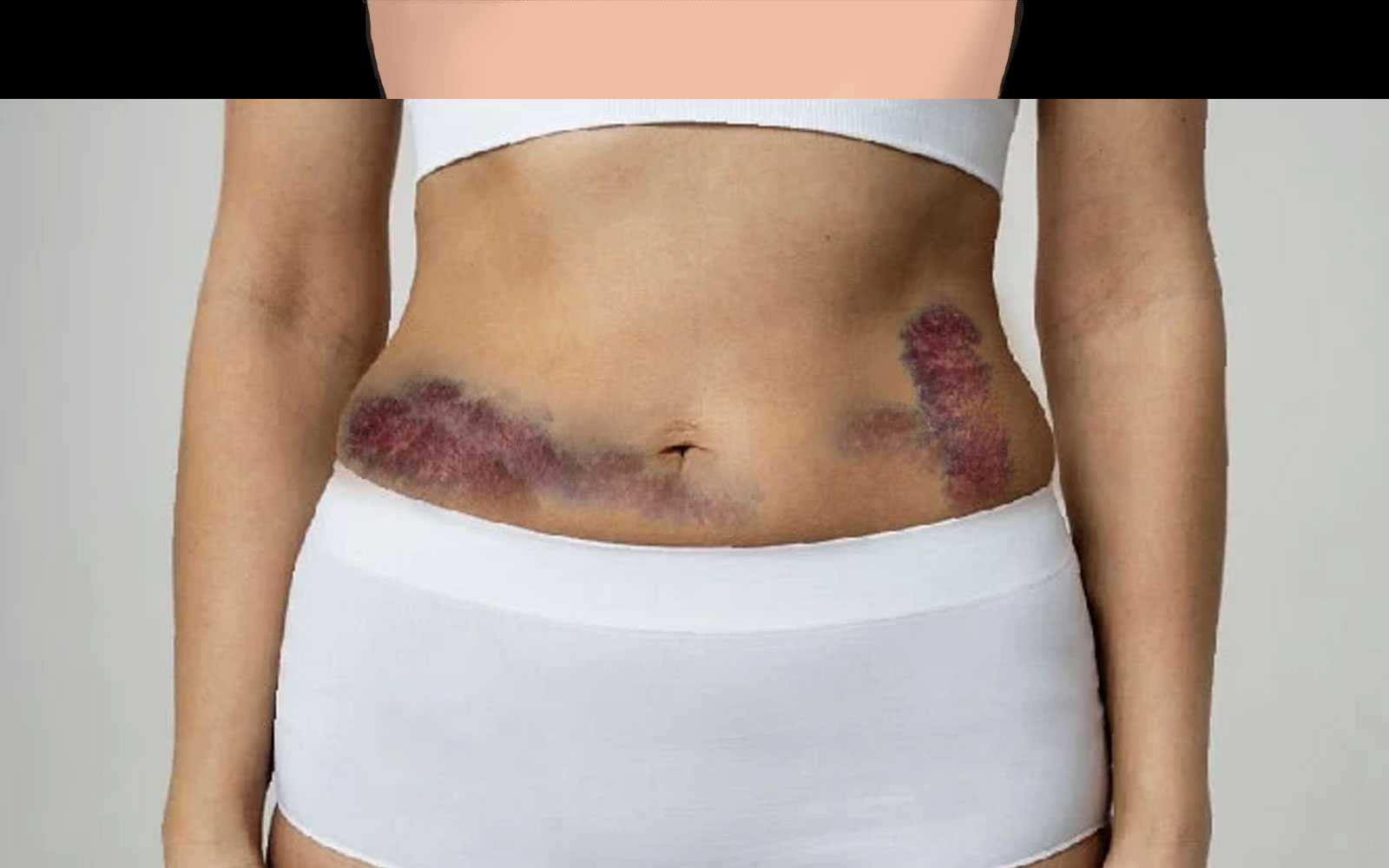 عوارض احتمالی لیپوساکشن سنتی 