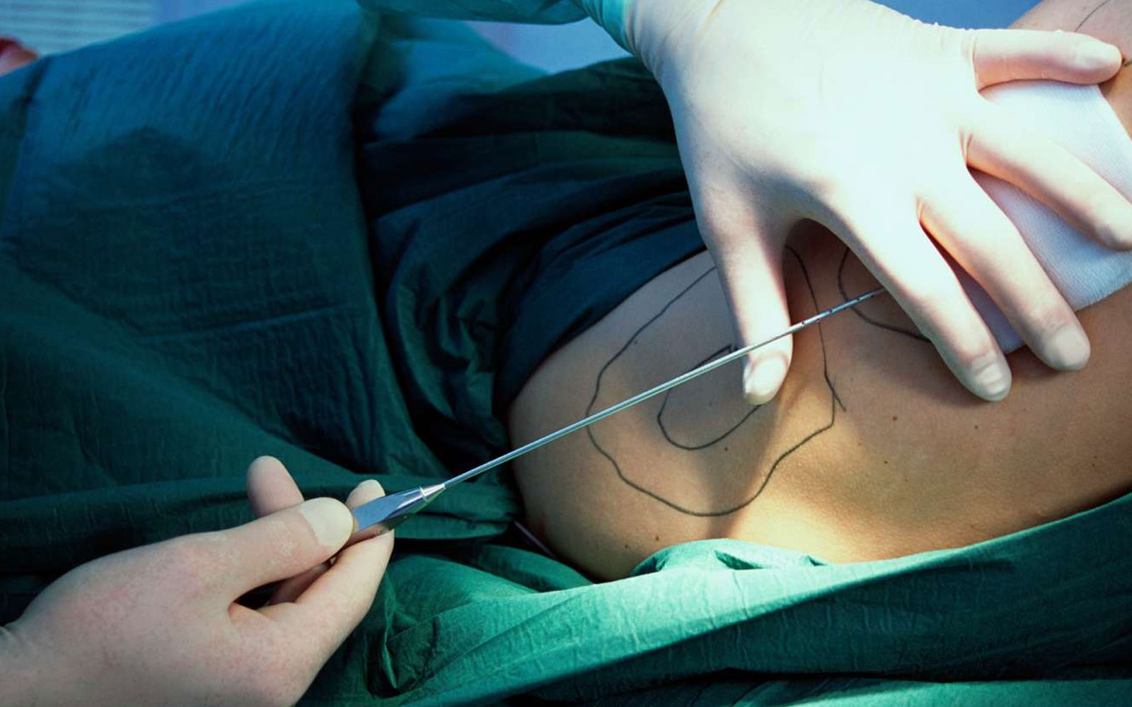 لیپوساکشن سنتی 