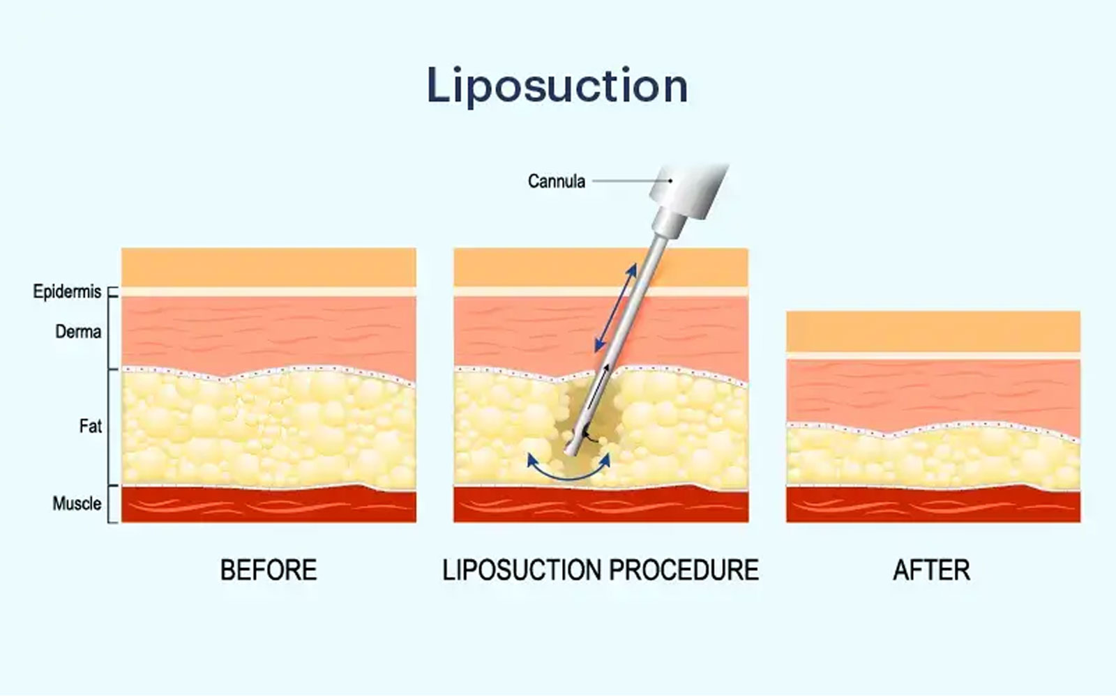 عمل لیپوساکشن برای لاغری